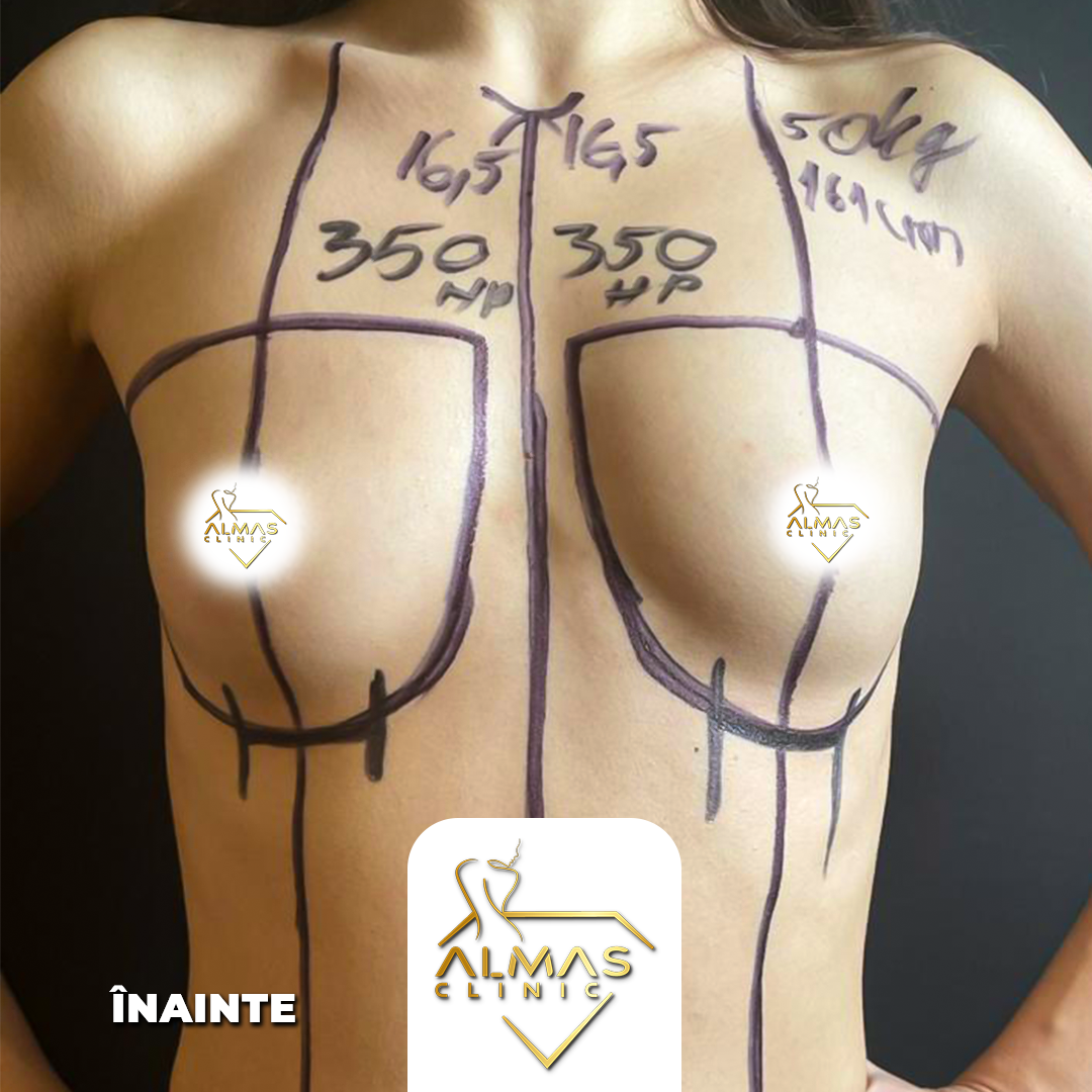 almas clinic implant mamar inainte