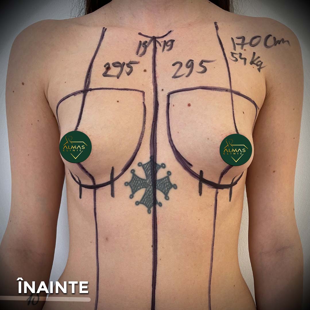 before implant mamar 2