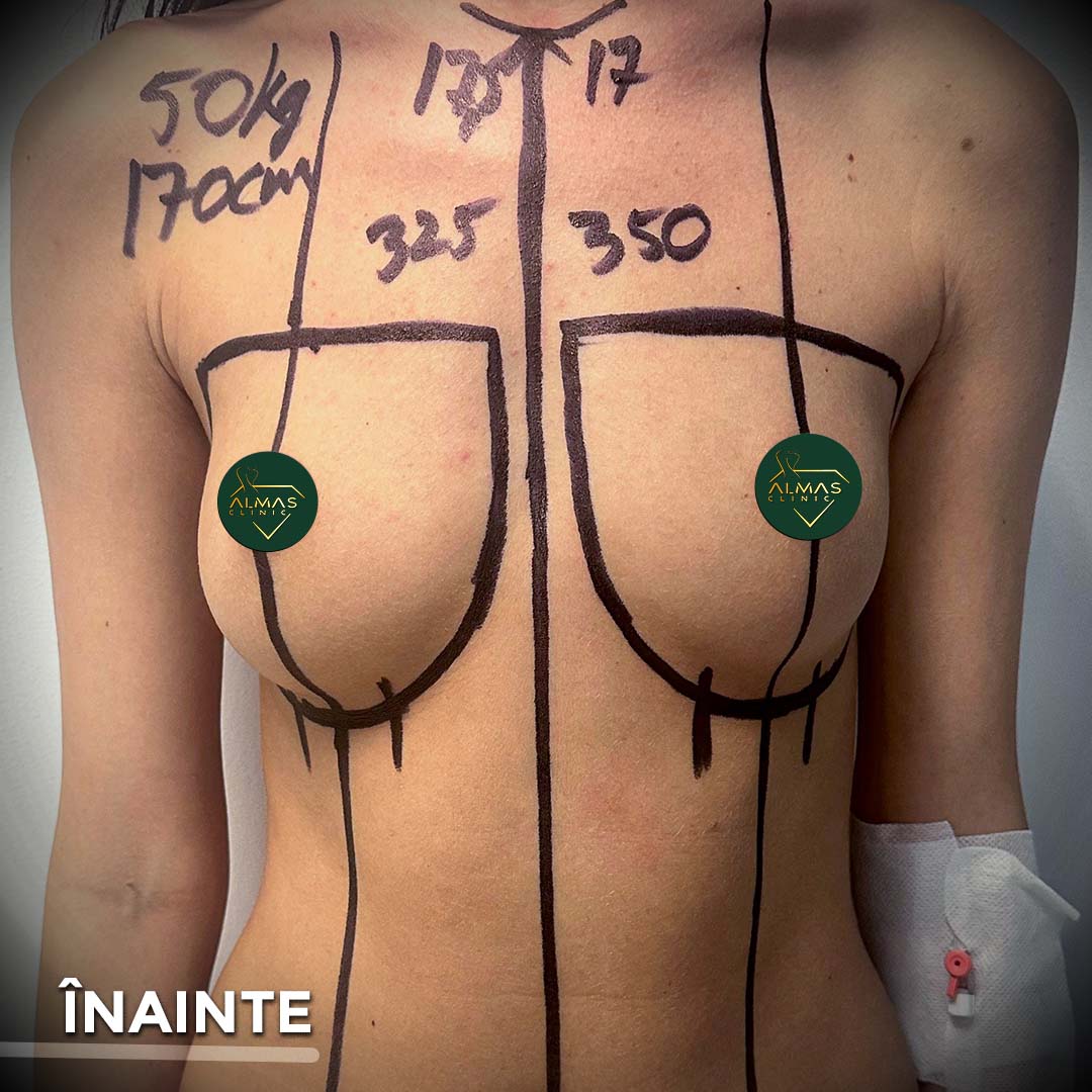 before implant mamar